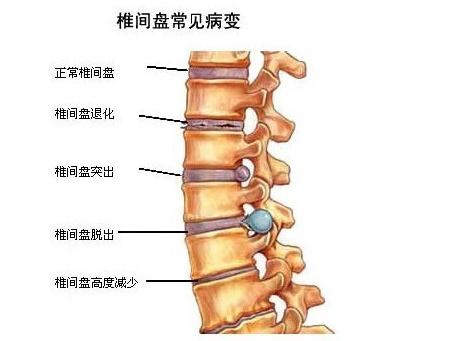 女人喊腰痛原來是這麼回事，早治療早好！