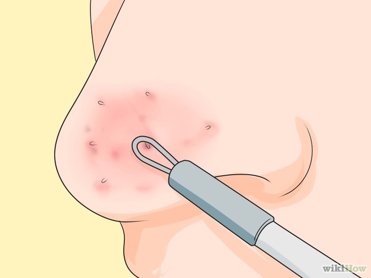 以Prevent Blackheads Step 10為標題的圖片