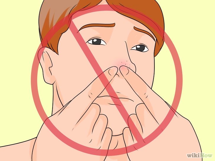 以Prevent Blackheads Step 9為標題的圖片