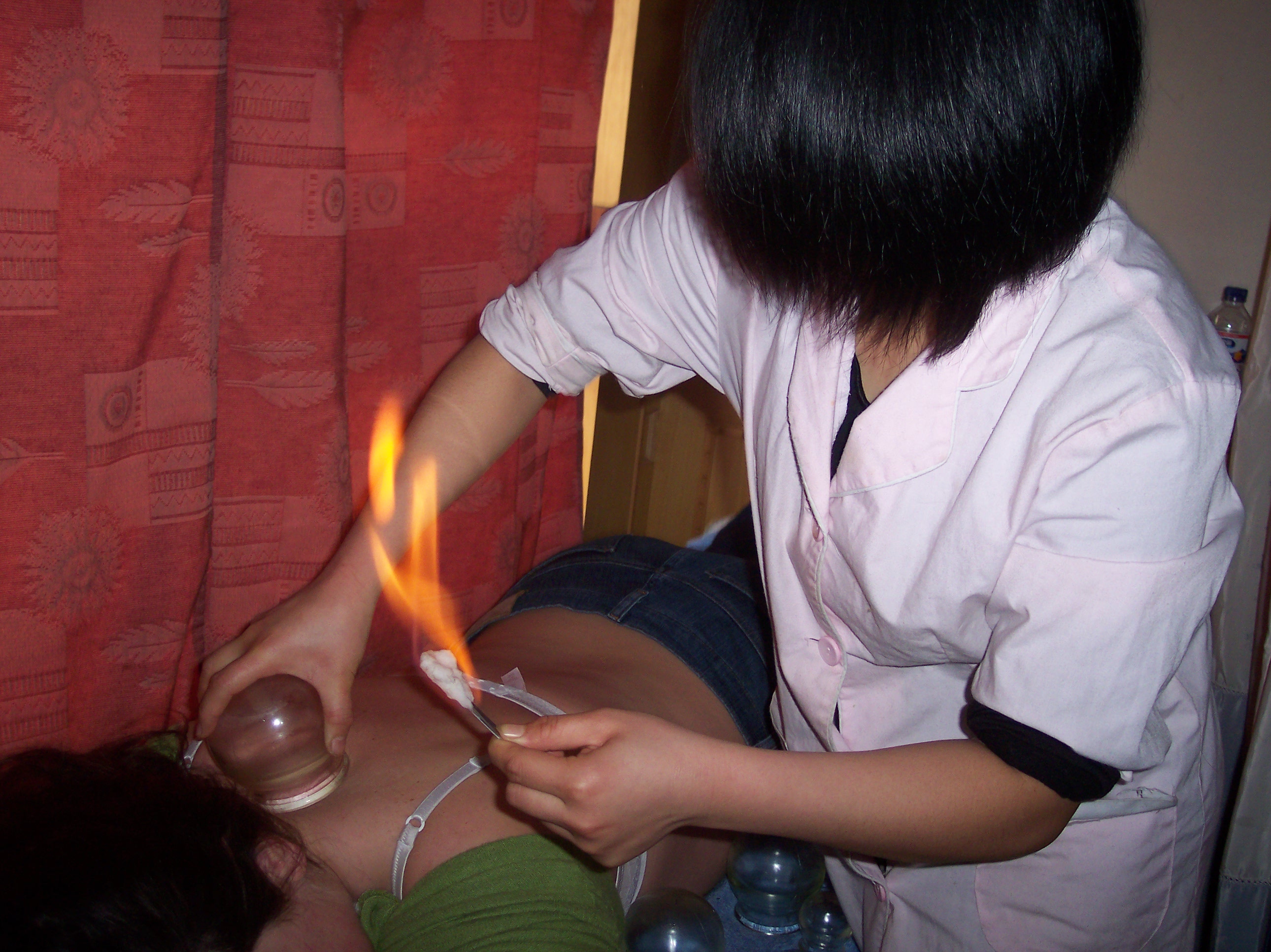 Fire_Cupping.jpg