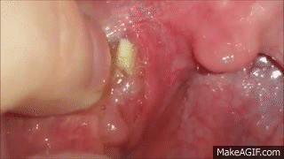 What_Are_Tonsil_Stones