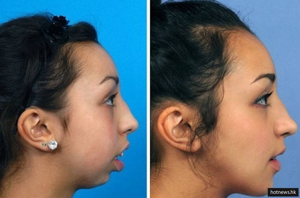 她歷經6年的時間做了這個罕見的臉部手術治療，從側邊看更覺得不可思議！