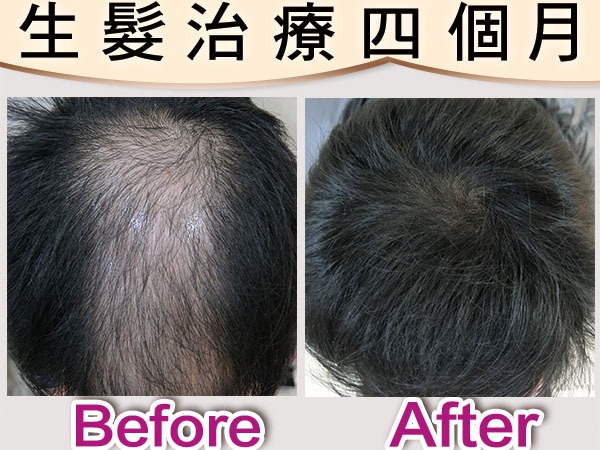 還在掉髮嗎？　及早求助專業團隊不需植髮