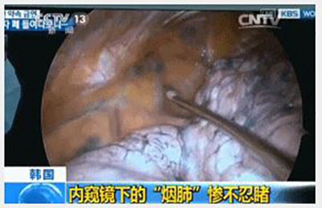 中國中央電視台 (CCTV) 日前播出了一段駭人的影片，讓長期吸菸的人能更真實地看到煙癮的後果。<BR><BR>