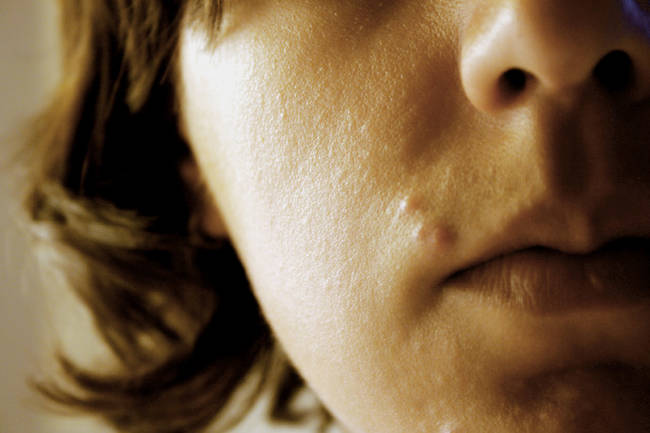 6.) 痘痘是因為毛孔堵塞，進而發炎所產生的，可能引發疼痛不適感。<BR><BR>