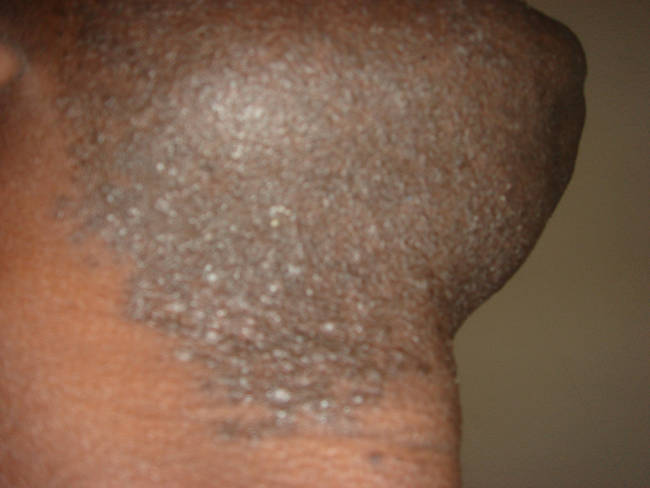 9.) 向內生長的毛髮有時相當疼痛，毛髮應該向外生長，卻被卡在毛細孔內。<!-- 電腦板-文章內插廣告-336X280 -->
<br><br>
<div align=