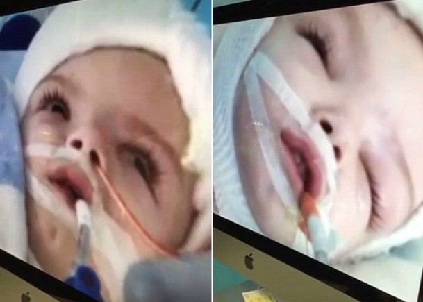 「頭腦相連雙胞胎兄弟」歷經20小時手術終於分開，他們「睜開眼睛那一刻」讓人太感動了！