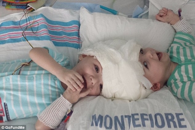 「頭腦相連雙胞胎兄弟」歷經20小時手術終於分開，他們「睜開眼睛那一刻」讓人太感動了！