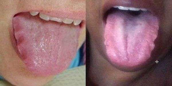 現在就伸出你的舌頭看看，如果出現這些狀況的話可要小心了！