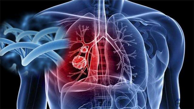 如果你有這6個症狀，請立刻戒菸：因為肺可能癌變了！