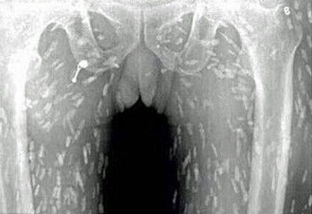 男子愛吃生魚片「皮膚癢癢的」，照X光發現竟然已經變成「蟲人」了！
