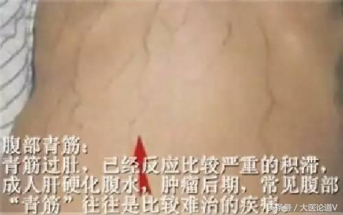 肝臟好不好，從眼睛、指甲、腹部一看便知｜三大名醫傳授養肝妙法