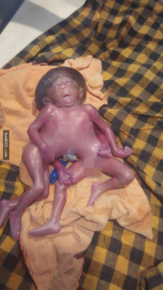 母親努力懷胎10月竟生下「4手4腳的畸胎」，醫生解釋他在腹中「吸收了其他手足」…