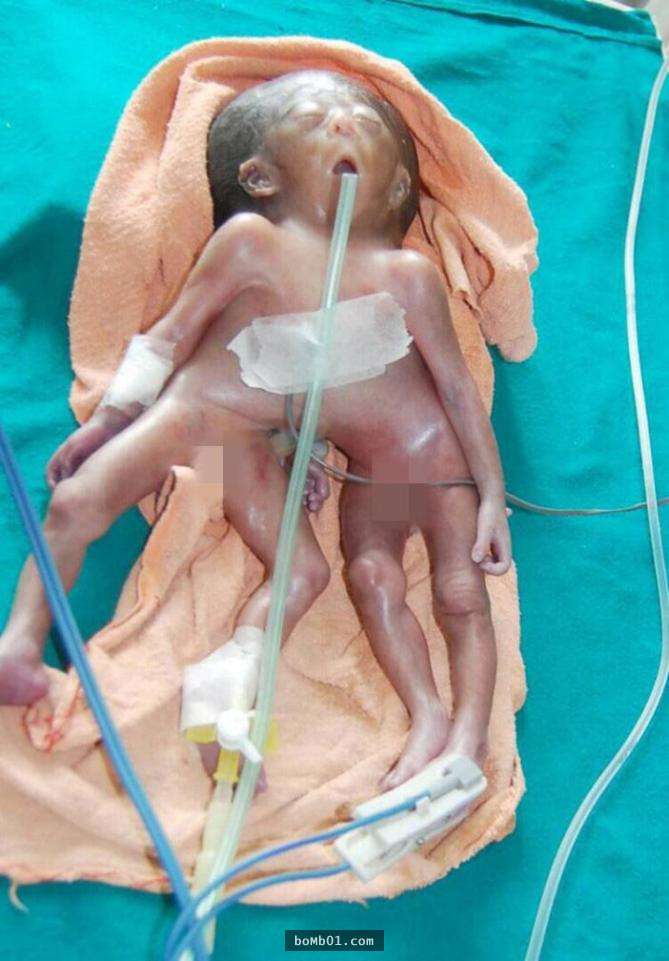母親努力懷胎10月竟生下「4手4腳的畸胎」，醫生解釋他在腹中「吸收了其他手足」…