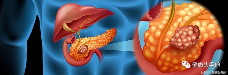 胰臟癌致死率高達95%，出現六大警訊不可忽略，三吃三不吃守護胰臟健康